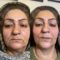 جشنواره هایفو مزوتراپی پی‌ار‌پی بوتاکس خالبرداری|خدمات آرایشگری و زیبایی|تهران, ایوانک|دیوار