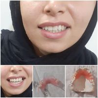 دندان سازی ساخت و تعمیر انواع دندانهای مصنوعی|خدمات آرایشگری و زیبایی|سمنان, |دیوار