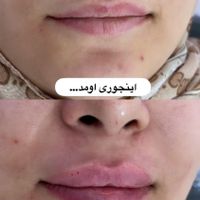 تزریق ژل وبوتاکس عربی،هایفوغبغب،پاک کردن تاتو|خدمات آرایشگری و زیبایی|تهران, نازی‌آباد|دیوار