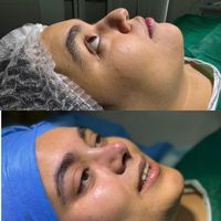 تیپ پلاستی (عمل بینی)|خدمات آرایشگری و زیبایی|تهران, سعادت‌آباد|دیوار