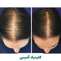 جشنواره هایفو مزوتراپی پی‌ار‌پی بوتاکس خالبرداری|خدمات آرایشگری و زیبایی|تهران, ایوانک|دیوار