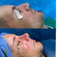 تیپ پلاستی (عمل بینی)|خدمات آرایشگری و زیبایی|تهران, سعادت‌آباد|دیوار