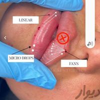 مدل ژل بوتاکس مزو امیریه|خدمات آرایشگری و زیبایی|تهران, امیریه|دیوار