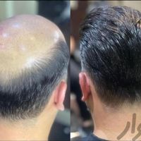 پروتز مو وارداتی ،کاشت hrt|خدمات آرایشگری و زیبایی|اصفهان, گلزار|دیوار