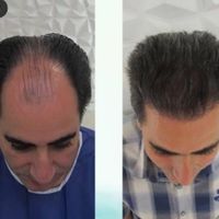 کاشت ابرو مو شقیقه ریش مزو تراپی نچرال طبیعی|خدمات آرایشگری و زیبایی|اصفهان, خانه اصفهان|دیوار