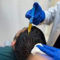 پی ار پی مو،صورت،اگزوزوم،مزوتراپی،هیرفیلر PRP|خدمات آرایشگری و زیبایی|تهران, هفت حوض|دیوار