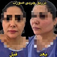 بوتاکس بلفارو لابیا تزریق‌ ژل نازی اباد‌ ستارخان|خدمات آرایشگری و زیبایی|تهران, نازی‌آباد|دیوار