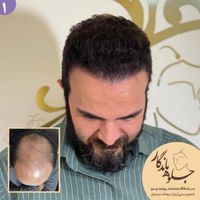 کاشت مو با خط رویش طبیعی و تراکم بالا|خدمات آرایشگری و زیبایی|تهران, عباس‌آباد|دیوار