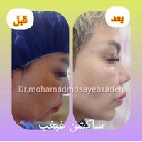 ساکشن تخصصی غبغب بهمراه کانتورینگ و تزریق چربی|خدمات آرایشگری و زیبایی|تهران, شهر زیبا|دیوار