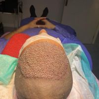 کاشت مو و ابرو فقط ۱۰ تومن|خدمات آرایشگری و زیبایی|تهران, پونک|دیوار