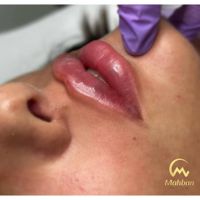 فیلرژل لب بوتاکس فیلر مادلینگ لیزرموهای زائدفشیال|خدمات آرایشگری و زیبایی|تهران, پیروزی|دیوار
