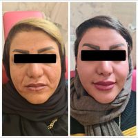 تزریق ژل لب و گونه و چانه و..(جشنواره)درمطب|خدمات آرایشگری و زیبایی|اصفهان, ملک‌شهر|دیوار