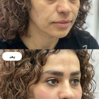 تزریق ژل وبوتاکس عربی،هایفوغبغب،پاک کردن تاتو|خدمات آرایشگری و زیبایی|تهران, نازی‌آباد|دیوار