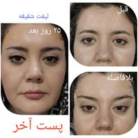 جراحی پلک بلفاروپلاستی لیفت صورت ابرو شقیقه بوتاکس|خدمات آرایشگری و زیبایی|تهران, آذربایجان|دیوار