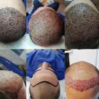 کاشت مو طبیعی دکتر رادمنش به روش سوپر sut|خدمات آرایشگری و زیبایی|اهواز, کیانپارس |دیوار