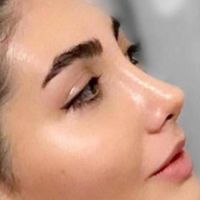 جراحی و عمل بینی/ لیفت صورت در کرج و تهران|خدمات آرایشگری و زیبایی|کرج, جهان‌شهر|دیوار