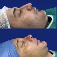 تیپ پلاستی (عمل بینی)|خدمات آرایشگری و زیبایی|تهران, سعادت‌آباد|دیوار