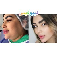 ساکشن غبغب بوکال فت بلفارو پیکرتراشی کاشت ابرو|خدمات آرایشگری و زیبایی|تهران, پونک|دیوار