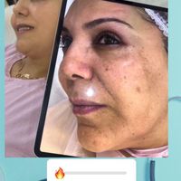 مرکز لاغری با۴دستگاه/ لیزر موزائد رفع‌لک prp هایفو|خدمات آرایشگری و زیبایی|تهران, صادقیه|دیوار