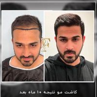 کاشت مو ابرو ریش بدون جراحی با پیشرفته ترین روش|خدمات آرایشگری و زیبایی|تهران, الهیه|دیوار