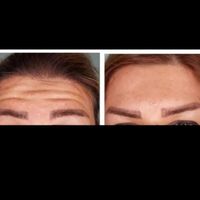 تزریق ژل لب و گونه و چانه و..(جشنواره)درمطب|خدمات آرایشگری و زیبایی|اصفهان, ملک‌شهر|دیوار