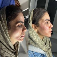 لیفت طبیعی کامل صورت ام دی کد کانتور صورت|خدمات آرایشگری و زیبایی|تهران, میرداماد|دیوار