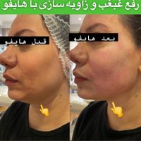 هایفو7D،هایفوتراپی،آراف فرکشنال،اموزش،اجاره|خدمات آرایشگری و زیبایی|تهران, سعادت‌آباد|دیوار