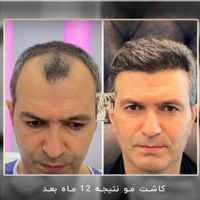 کاشت مو ابرو ریش بدون جراحی با پیشرفته ترین روش|خدمات آرایشگری و زیبایی|تهران, الهیه|دیوار