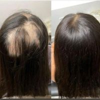مرکز پروتز مو و کاشت مو|خدمات آرایشگری و زیبایی|اصفهان, خرم|دیوار