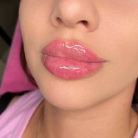 ژل ‌بوتاکس ‌بلفارو  فیلربادی آنزیم لیزر و نخ مزو|خدمات آرایشگری و زیبایی|کرج, گوهردشت|دیوار