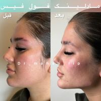 تزریق تخصصی فیلر زیرچشم ژل لب روسی لیفت بینی گونه|خدمات آرایشگری و زیبایی|تهران, پونک|دیوار