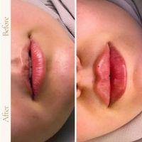 نیاز به مدل رایگان فیلر لب در مطب پزشک زیبایی|خدمات آرایشگری و زیبایی|تهران, سلسبیل|دیوار