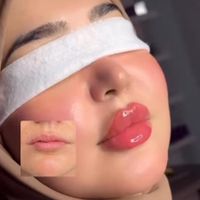 تزریق ژل.بوتاکس.مزوتراپی.فشیال.جوانساز|خدمات آرایشگری و زیبایی|تهران, پیروزی|دیوار