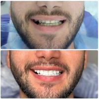 کامپوزیت زیبایی دندان|خدمات آرایشگری و زیبایی|تهران, سعادت‌آباد|دیوار