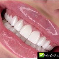 تخفیفات نوروزی کامپوزیت دندان آفر ویژه|خدمات آرایشگری و زیبایی|تهران, تهران‌سر|دیوار