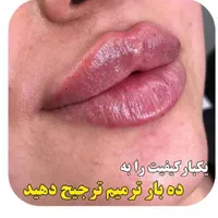 جشنواره ژل لب روسی زاویه سازی فیلر لب بوتاکس و...