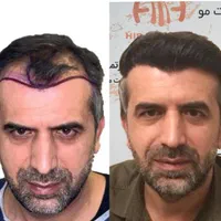 کاشت مو.ابرو.ریش درکیلنیک تخصصی