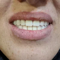 دندانپزشکی .دست دندان  هر فک ۴ میلیون تحویل ۳ روزه|خدمات آرایشگری و زیبایی|اسلام‌شهر, |دیوار