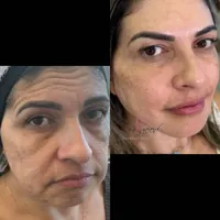 آموزش فیلر و بوتاکس صد درصد یادگیری|خدمات آموزشی|اهواز, کیانپارس |دیوار