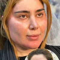 بوتاکس و لاغری و لیزر و تزریق چربی و فیلر لب،هایفو|خدمات آرایشگری و زیبایی|یزد, |دیوار