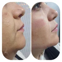 جنشواره تخفیفی مهرماه تزریق مزوژل-فیلر-بوتاکس|خدمات آرایشگری و زیبایی|دوگنبدان, |دیوار