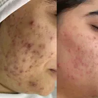 کلینیک پوست/درمان لک/جوش جای جوش/مزونیدلینگ/فشیال|خدمات آرایشگری و زیبایی|مشهد, فرهنگ|دیوار