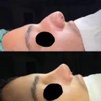 جراحی زیبایی بینی (جشواره)|خدمات آرایشگری و زیبایی|تهران, صادقیه|دیوار