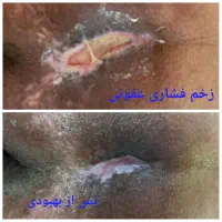 ترمیم زخم قطعی به شیوه نوین باقیمت ارزان|خدمات آرایشگری و زیبایی|اصفهان, سلطان‌آباد|دیوار
