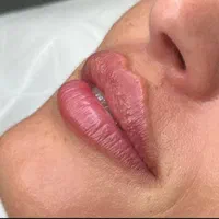 جشنواره تزریق فیلر و بوتاکس