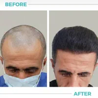 کاشت موی طبیعی به روش fit ،و سوپر sut