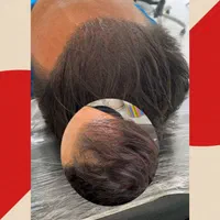اسکالپ میکرواسکالپ|خدمات آرایشگری و زیبایی|تهران, دریاچه شهدای خلیج فارس|دیوار