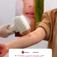 لیزر موی زاید تضمینی زیر نظر پزشک