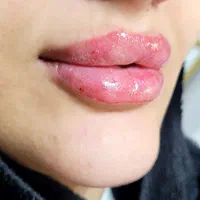 جوانسازی با تزریق ژل و بوتاکس|خدمات آرایشگری و زیبایی|تبریز, |دیوار