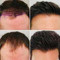 کاشت مو،ابرو،ریش فوق تخصصی باتراکم بالا